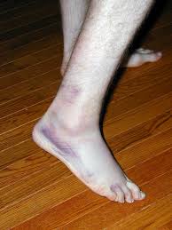 sprained ankle