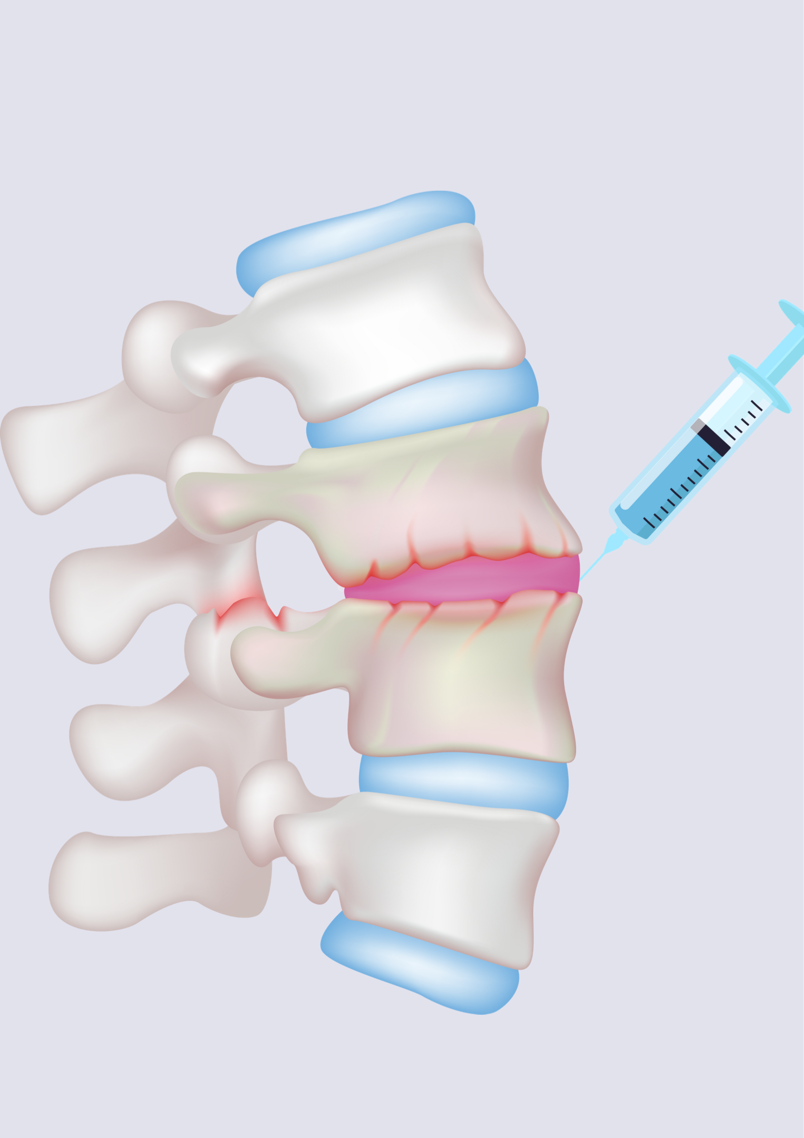 Will A Spinal Injection Take Away the Pain? - Zang Physical Therapy
